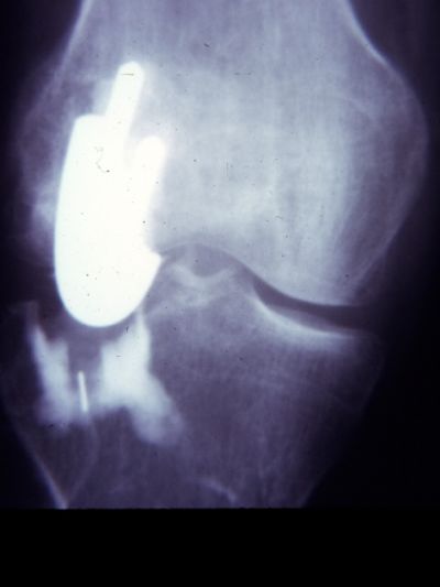 Howmedica Polycentric (Implant 158)